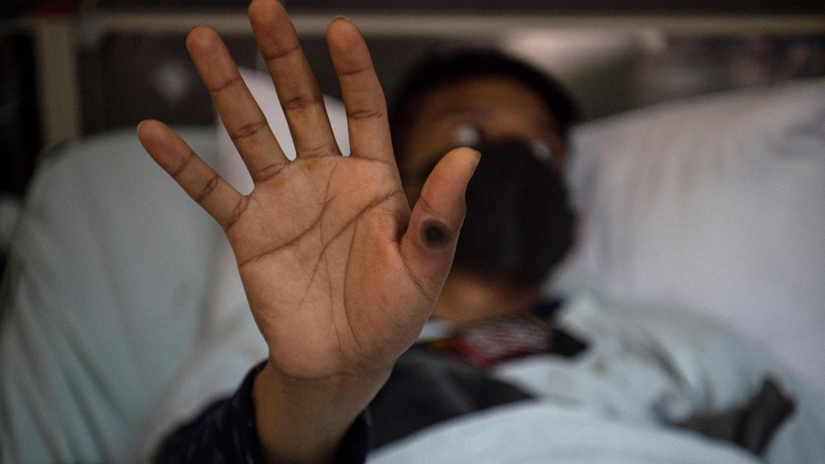 Mpox explainer Symptoms, transmission, prevention of monkeypox virus